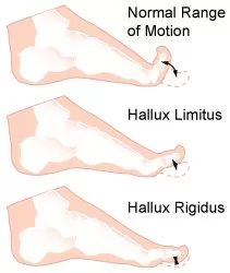 Read more about the article Hallux Rigidus Shoes (and Hallux Limitus)
